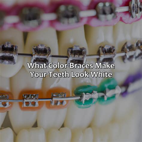 white braces color chart.